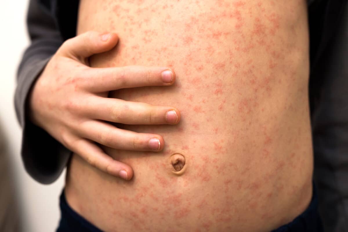 Child with measles rash